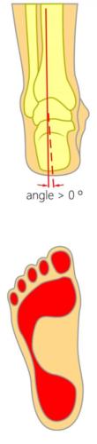 Over supination supinated cavus foot heel pain