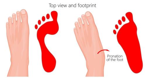 Overpronation foot