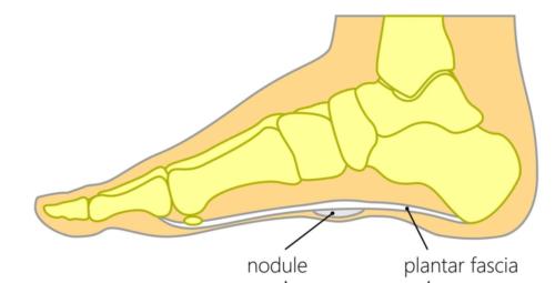 plantar fibromatosis treatment