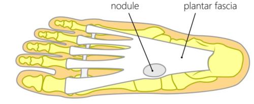 plantar fibroma treatment