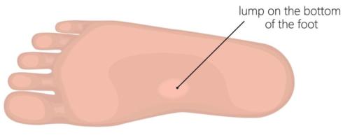 plantar fibromatosis treatment