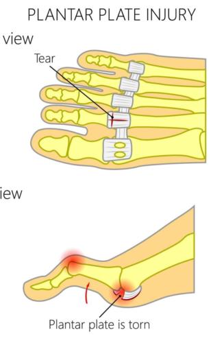 Plantar plate injury to the 2nd toe joint with tear repair