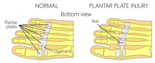 Plantar plate tear injury to the 2nd toe joint