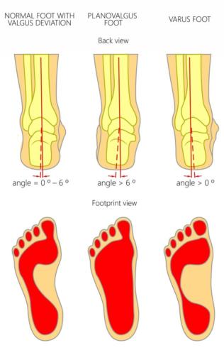 Pronated foot vs supinated foot heel pain