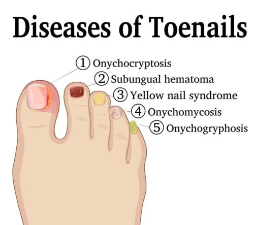 Toenail Disease Ingrown toenail, hematoma, yellow toenail, onygryphosis