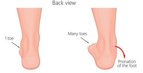 Too many toes sign overpronation top of the foot pain
