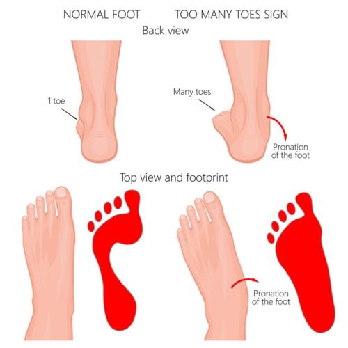 Too many toes sign overpronation