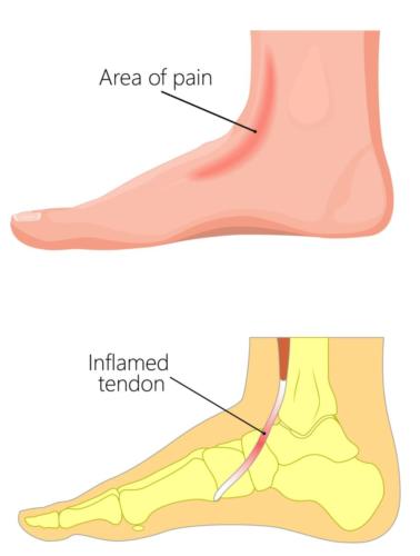 Top of the foot anterior tibialis