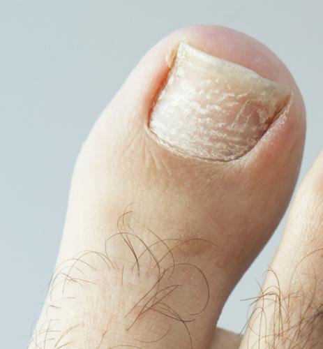 Cracked Fungus Toenails