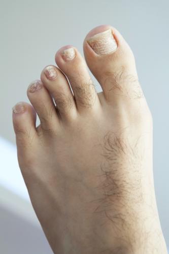 White nails: white spots, white marks & white toenail fungus