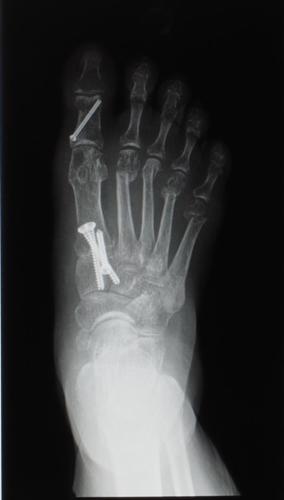 After bunion xray