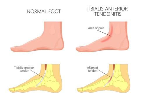 anterior tibial tendon pain top of the foot