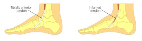 anterior tibial tendonitis top of the foot