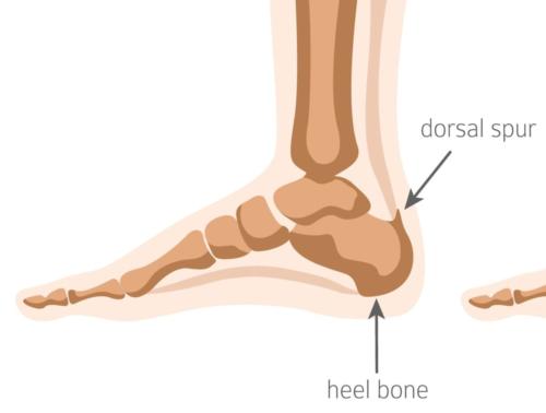 Insertional Achilles Tendonitis