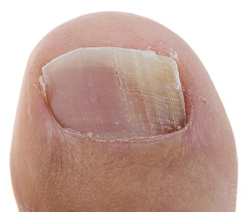 Toenail Fungus Onychomycosis stage #1