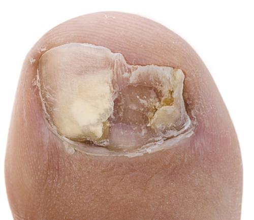 Toenail Fungus Onychomycosis #5