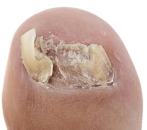 Toenail Fungus Onychomycosis #6