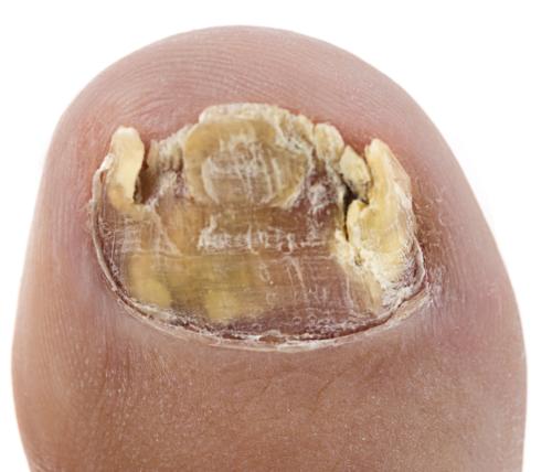 Toenail Fungus Onychomycosis #8