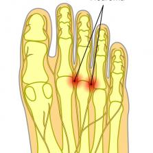 Ball of the foot pain Morton's Neuroma
