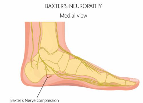 Plantar fasciitis nerve pain heel