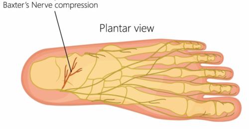 Heel nerve pain