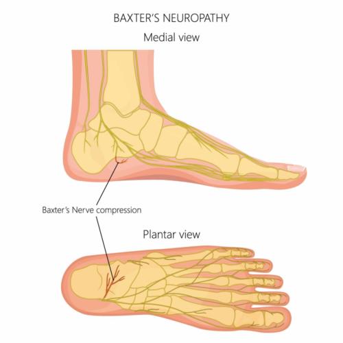 Baxter's nerve entrapment pinched nerve heel pain