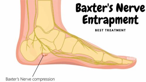 Pinched nerve heel pain at night