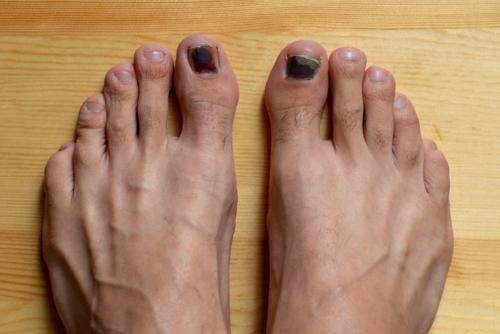 Big toenail black and red