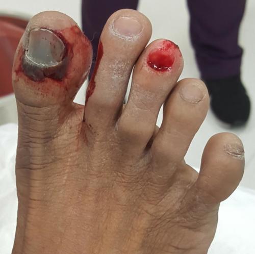 Right great toe fracture and right 3rd toe fracture.
