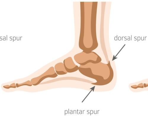 Bottom and back of the heel spurs