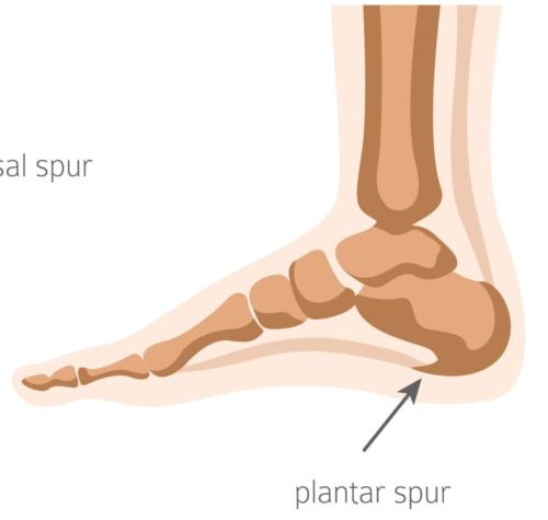 Plantar heel spur heel pain