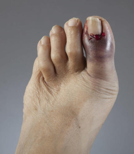 Throbbing Big Toe Pain At Night