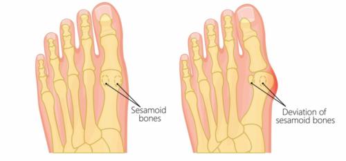 Bunion before and after sesamoid dislocation