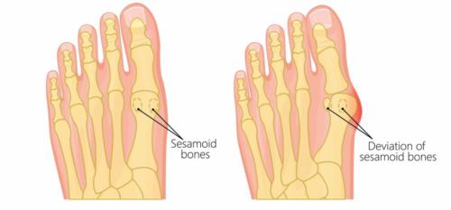 Bunion before and after sesamoid dislocation