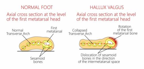 Bunion before and after transverse plane