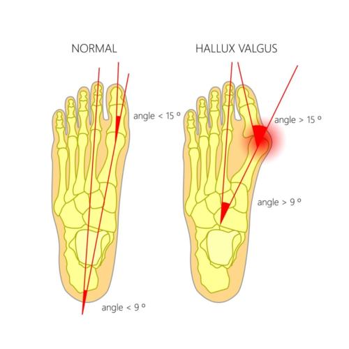 Bunion Causes Stages Treatment