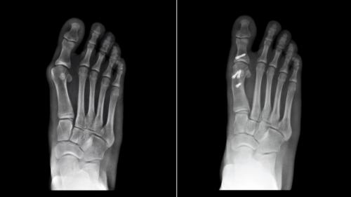 Bunion Surgery before and after Xray metatarsal osteotomy