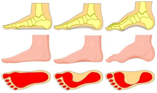 Cavus foot type vs pes planovalgus foot type heel pain