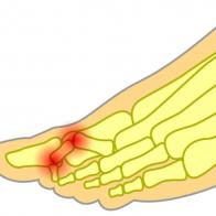 Claw toe pain 2nd toe joint