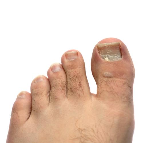 White nails: Superficial white onychomycosis, white spots, white marks & white toenail fungus.
