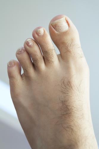 White nails: Superficial white onychomycosis, white spots, white marks & white toenail fungus.