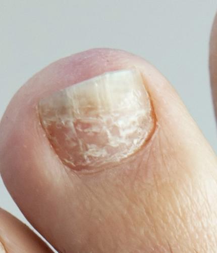 White nails: Superficial white onychomycosis, white spots, white marks & white toenail fungus.