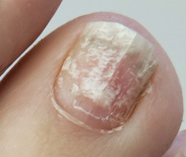 White nails: Superficial white onychomycosis, white spots, white marks & white toenail fungus.