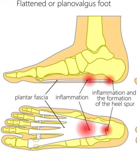 Flat foot heel pain plantar fasciitis