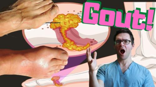 Do Podiatrists Treat Gout? Best Doctor for Big Toe & Foot Gout!