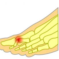 Hammer toe pain 2nd toe