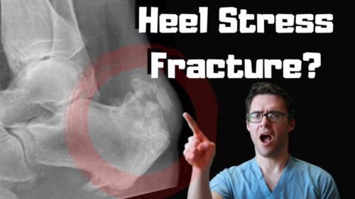 Calcaneal stress fracture Heel stress fracture treatment