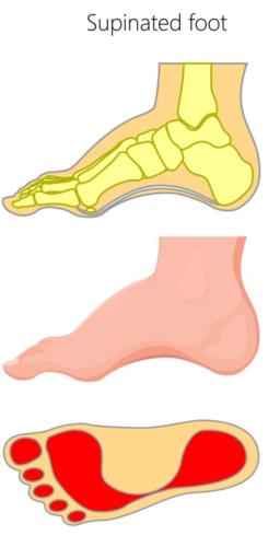 High arch supination foot type heel pain