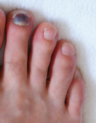 Subungual hematoma with blood and black toenail.