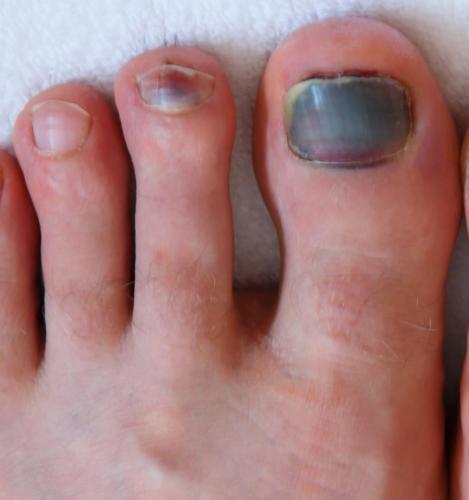 Bruised Toenail: Causes & Best Treatment: